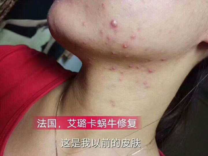 21岁男生,皮肤非常差,请帮我看看有哪些问题?(有图)
